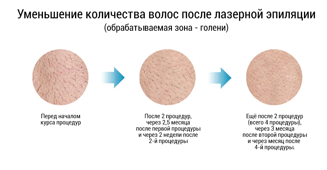 Сколько держится эффект после электроэпиляции?