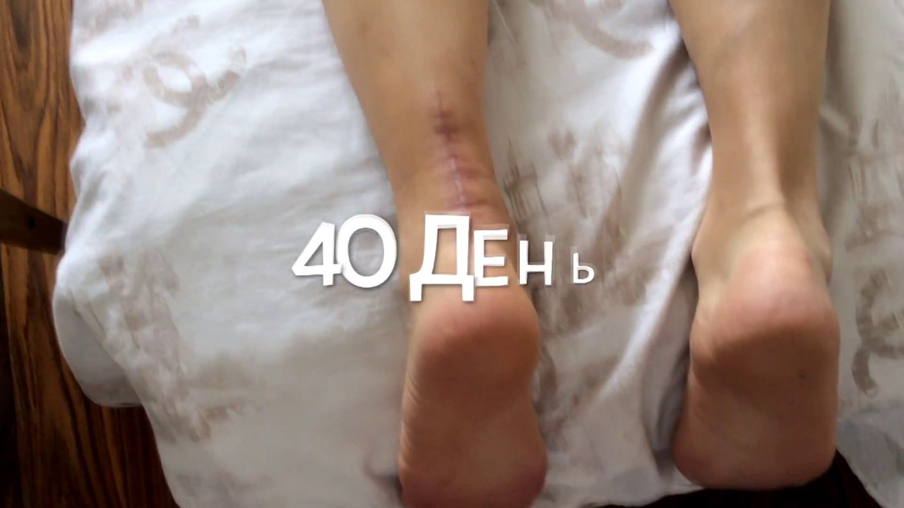 Сколько ходить в гипсе после разрыва Ахилла?