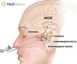 Сколько можно жить с аденомой гипофиза?