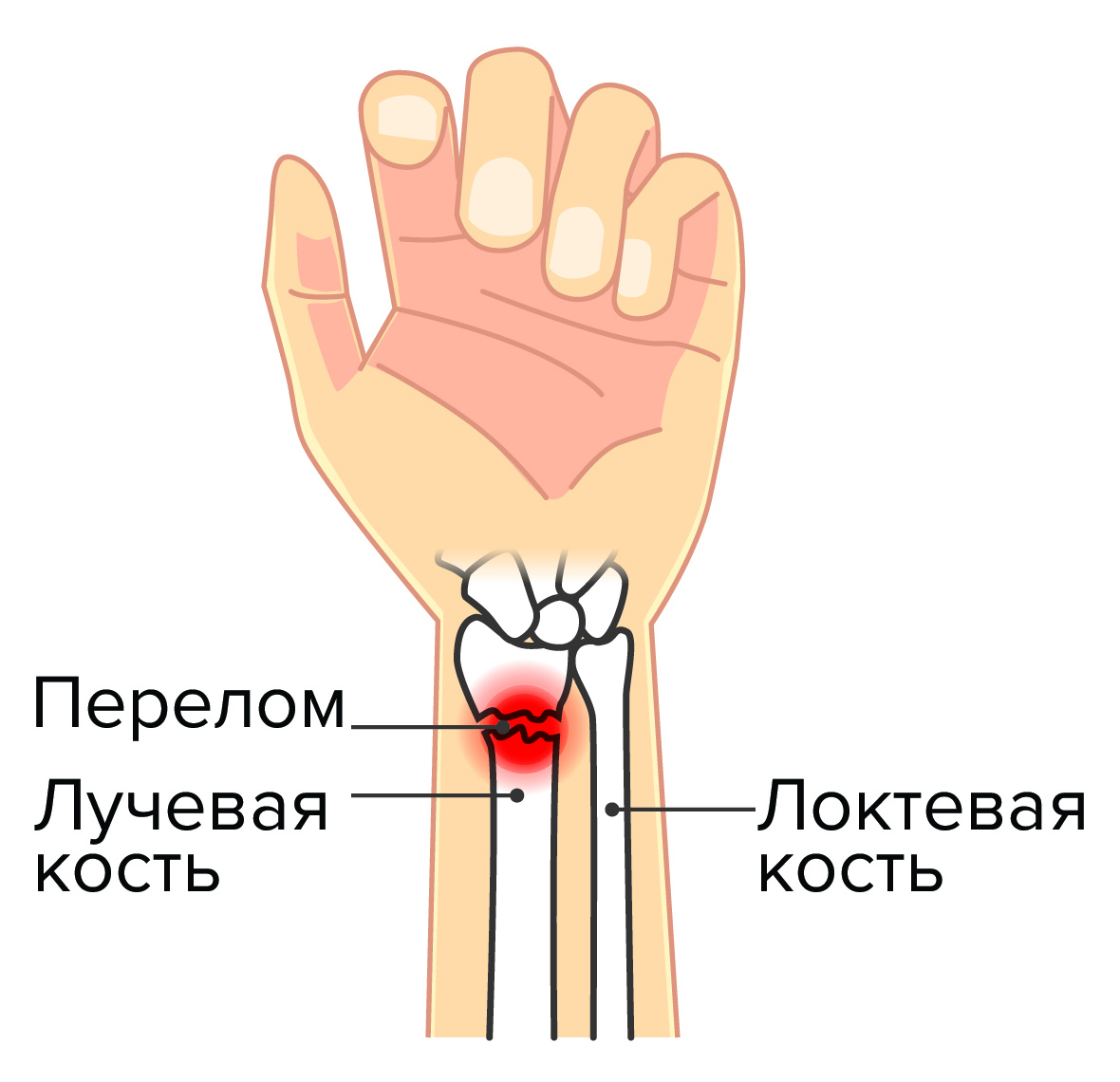 Сколько носить гипс при переломе запястья?