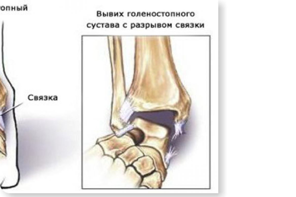 Сколько по времени срастается сухожилие?