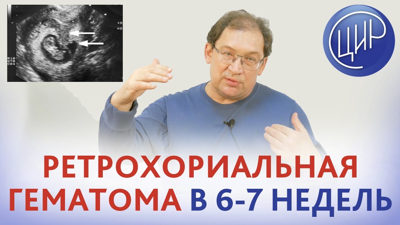 Сколько выходит Гематома на ранних сроках беременности?