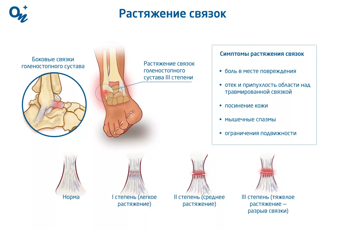 Сколько заживают связки на лодыжке?