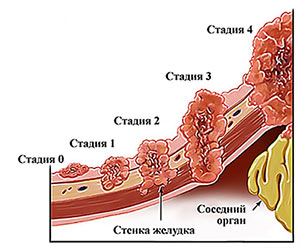 Сколько живут с раком крови последней стадии?
