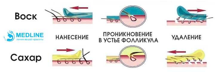 В чем разница Ваксинга и шугаринга?